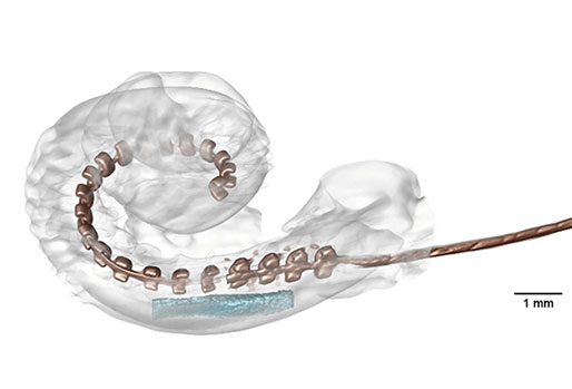 Implant